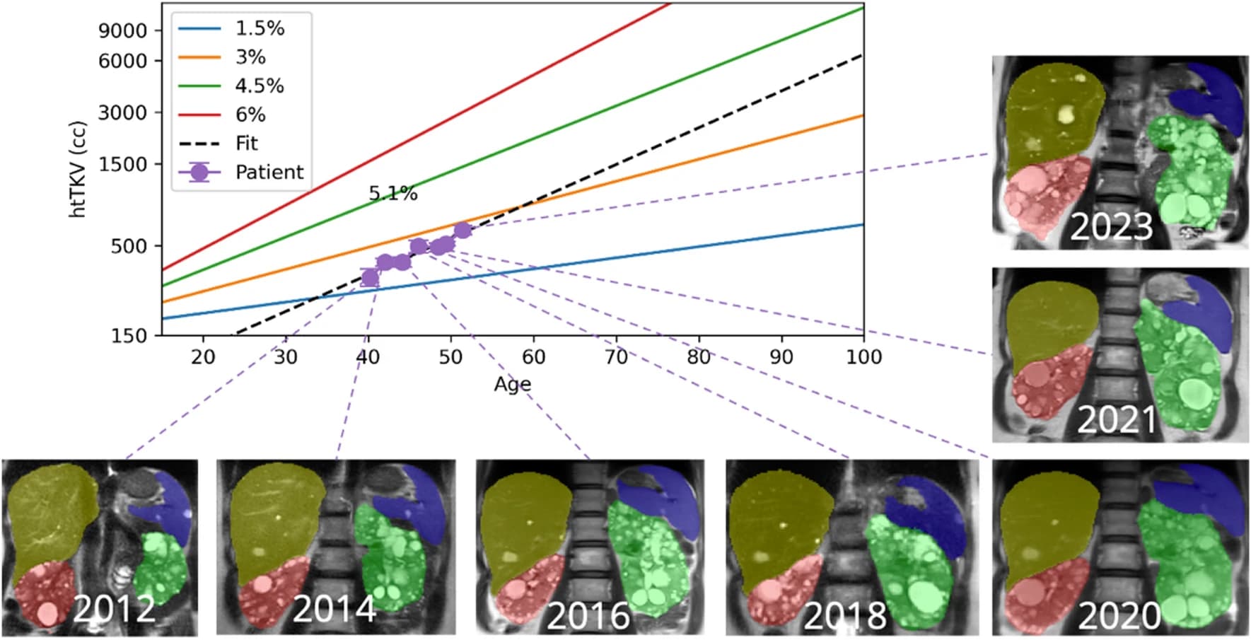 Figure for Improved predictions of total kidney volume growth rate in ADPKD using 2-parameter LSF